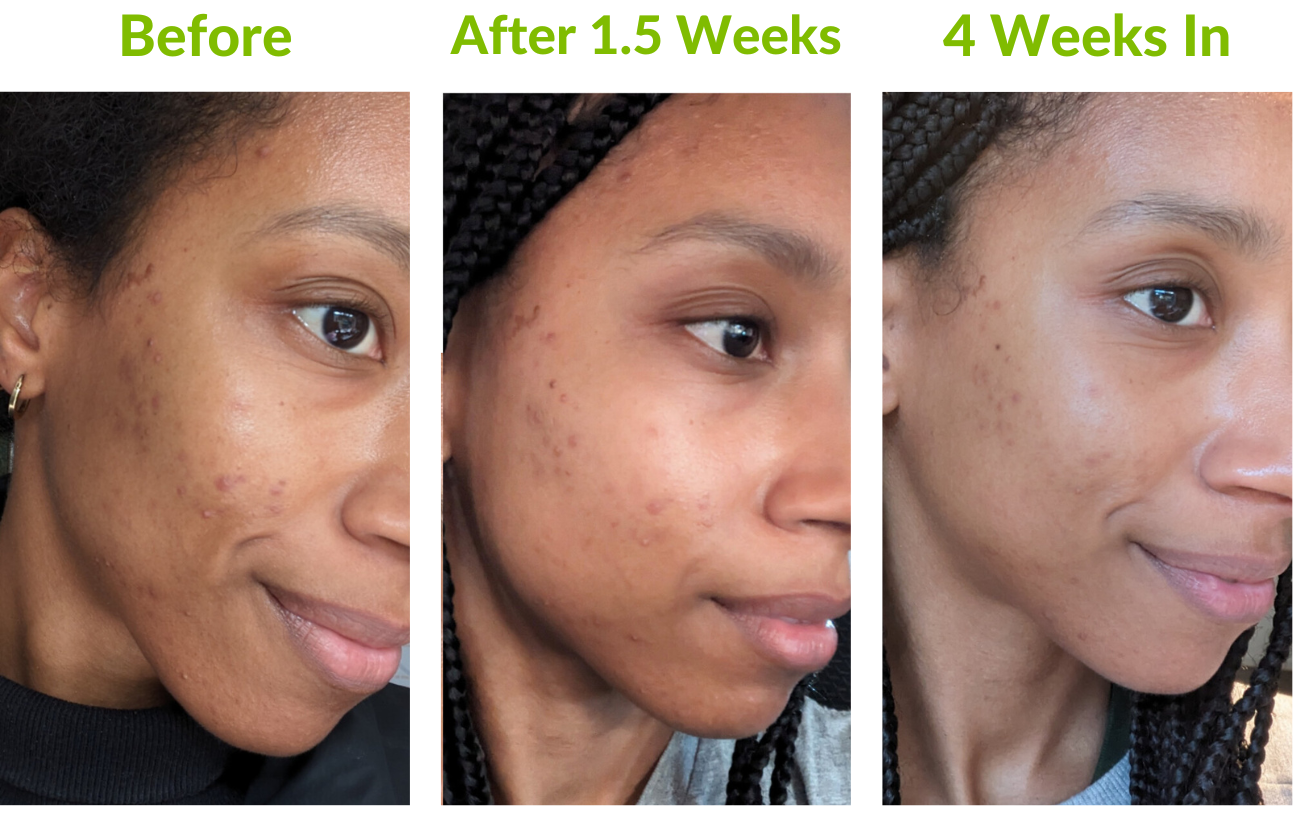 From Hormonal Breakouts & pigment to Healthy and Hydrated