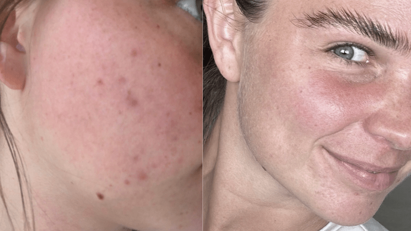 Ebony's Journey: Healing Dehydrated Skin and Hormonal Breakouts for Lasting Confidence - Fresh Face Skin