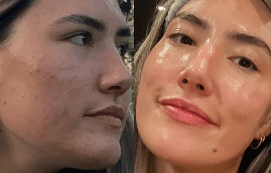 Rachael's Journey: Triumph Over Sensitive, Acne-Prone Skin - Fresh Face Skin