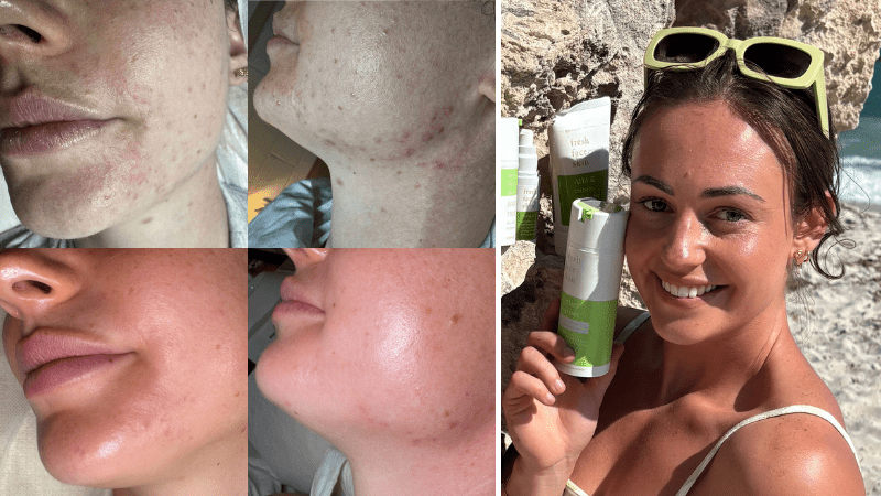 Healing Perioral Dermatitis & Hormonal Acne: A Journey to Self Love - Fresh Face Skin