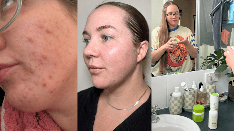 Breakout-Prone Skin? The Case for a Calmer Routine - Fresh Face Skin