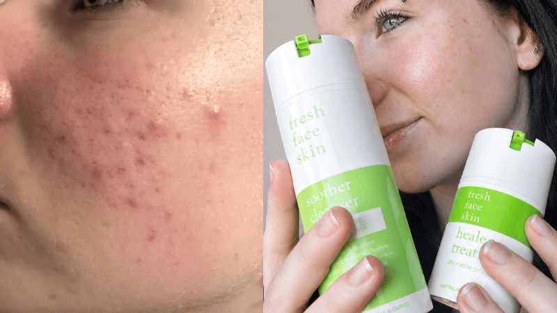 From teenage breakouts to calm, confident skin - Fresh Face Skin