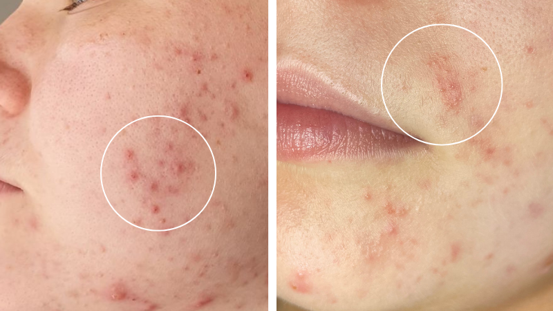 Perioral Dermatitis or Acne? How to Tell the Difference