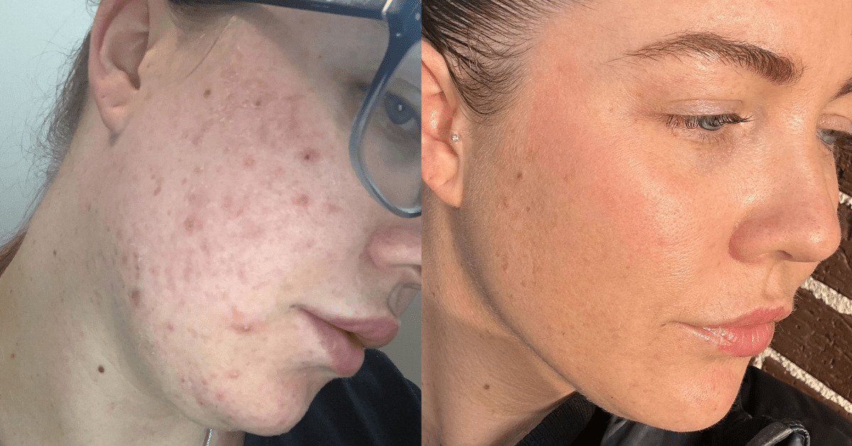 Kiara’s Skin Journey: From Inflamed Hormonal Acne to Calm, Makeup-Free Confidence - Fresh Face Skin