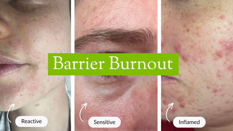 Barrier Burnout: What It Looks Like and How to Support Your Skin