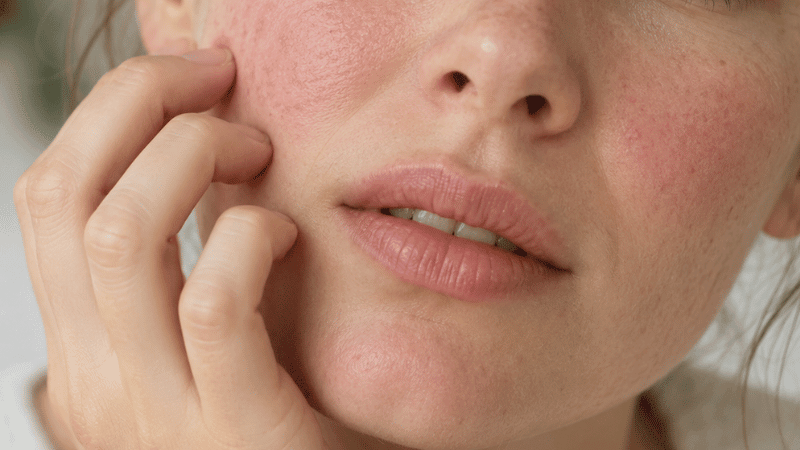 Spring Skin Survival Guide: How to Support Reactive &amp; Sensitive Skin During Allergy Season - Fresh Face Skin