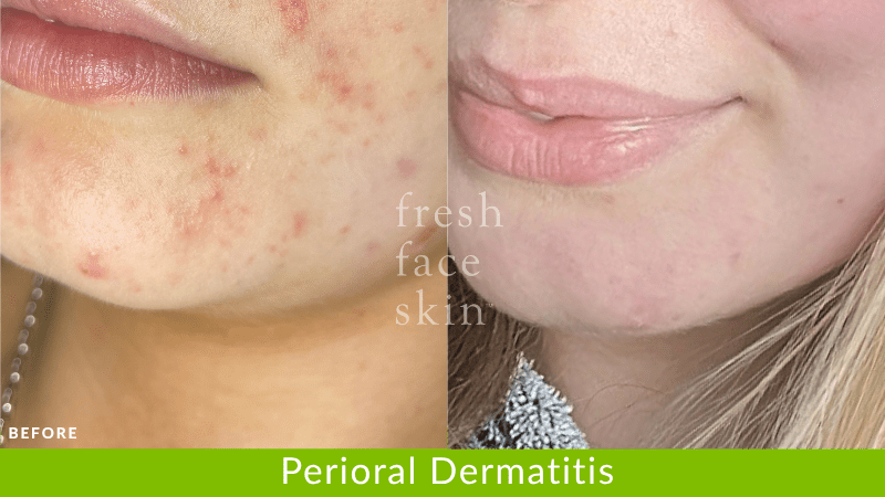 Perioral Dermatitis Flare-Up? 5 Things That Could Be Triggering It That You May Not Have Considered - Fresh Face Skin
