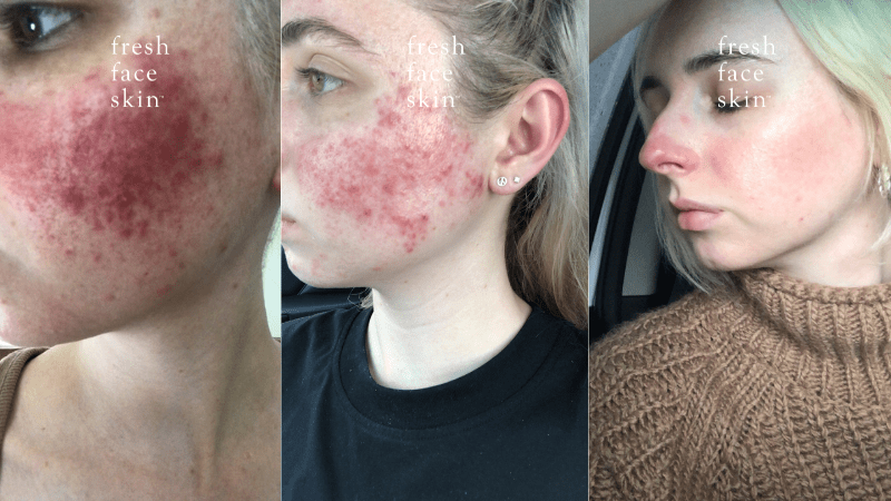 Tanae's Real Skin Journey: From Persistent Acne Rosacea to Feeling Confident in Her Skin - Fresh Face Skin