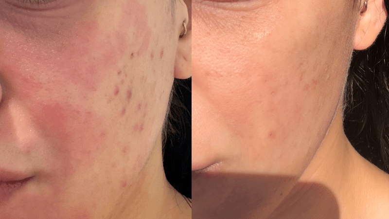 “My Skin Was Destroying My Confidence”: Mel’s Facial Eczema & Breakout Story - Fresh Face Skin