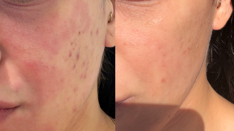 “My Skin Was Destroying My Confidence”: Mel’s Facial Eczema & Breakout Story