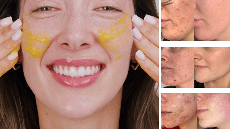 The Power of Natural Acids - Fresh Face Skin