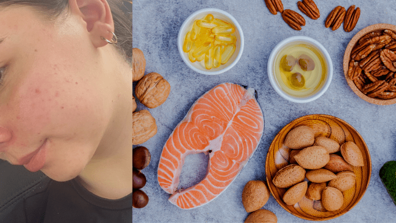 Acne & Diet: Foods That Trigger Breakouts and Clear Your Skin Naturally - Fresh Face Skin
