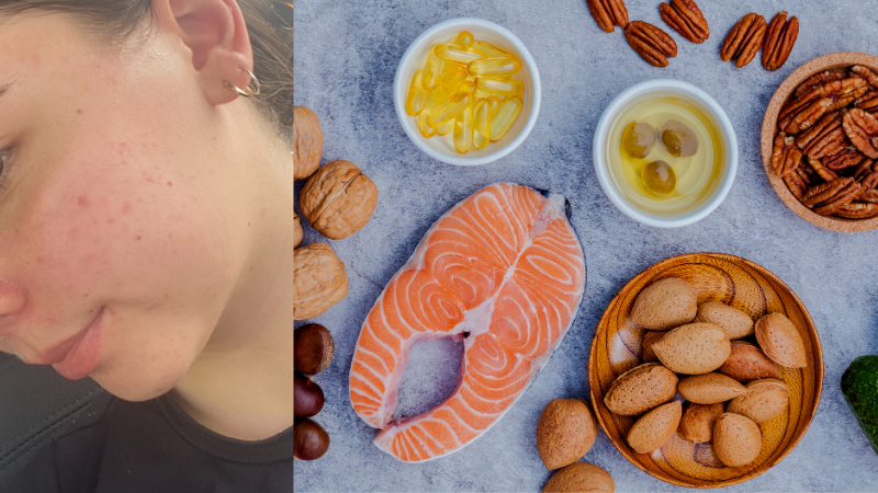 Acne & Diet: Foods That Trigger Breakouts and Clear Your Skin Naturally