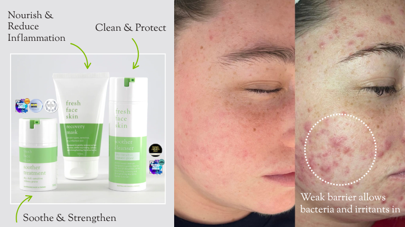 How Do You Know If Your Skin Barrier Is Impaired?
