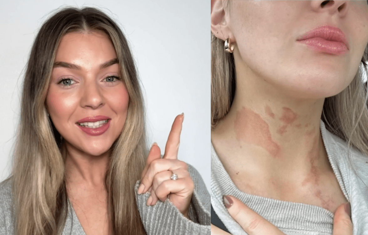 Dana’s skin journey battling with sensitivity and eczema - Fresh Face Skin