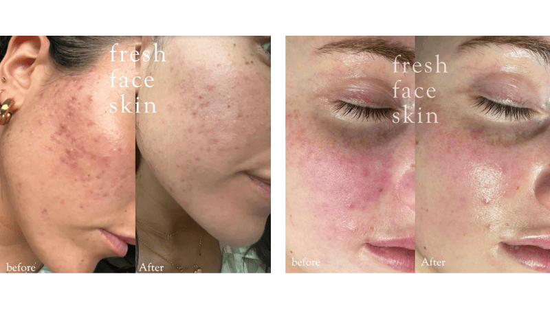 The Secret to Calming Inflammatory Skin Conditions: The Power of a Healthy Barrier - Fresh Face Skin