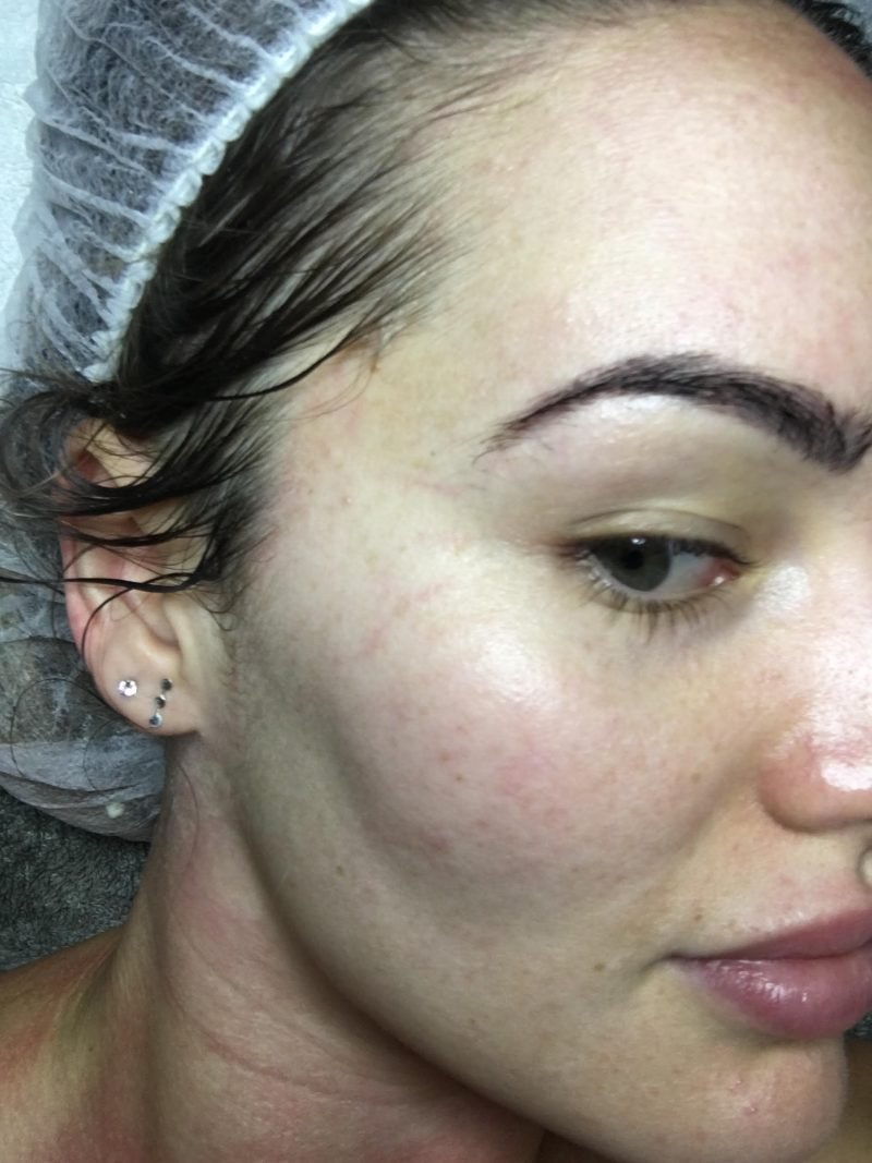 Professional skin treatments are a workout for the skin - Fresh Face Skin