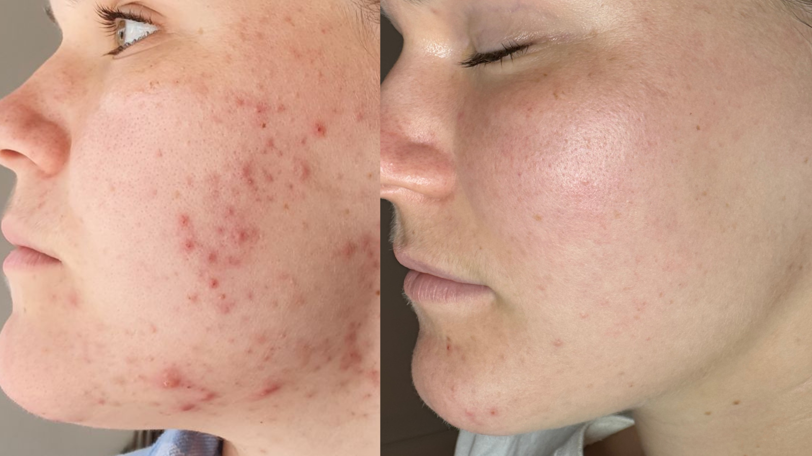 Georgia’s Skin Journey: From Struggling With CysticAcne to Feeling Confident in Her Skin Again