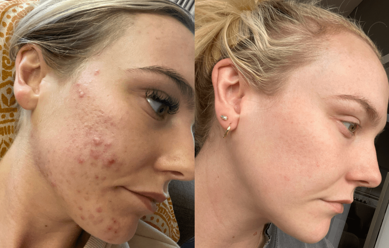 Hayley Love's Cystic Acne Journey - Fresh Face Skin