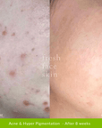 Healer Treatment - Fresh Face Skin