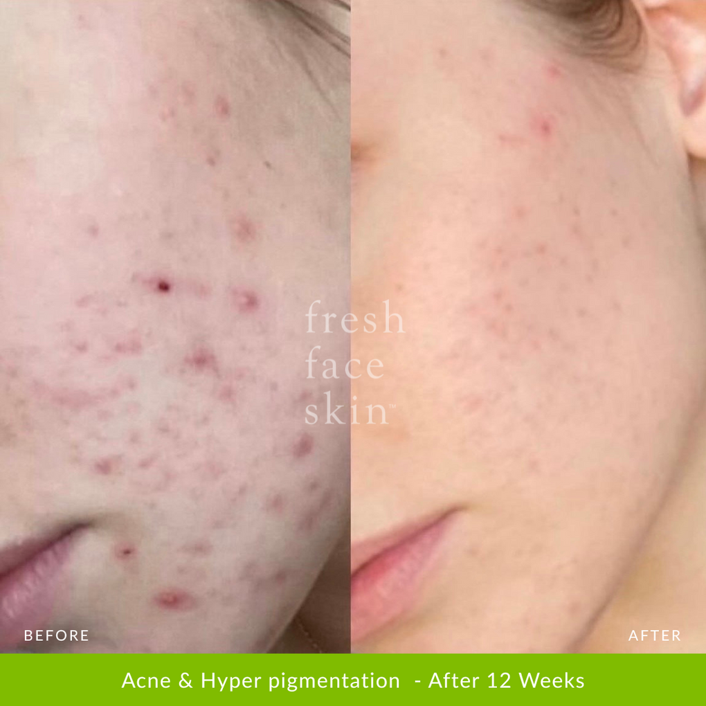 Acne & Hyper pigmentation  - After 12 Weeks
