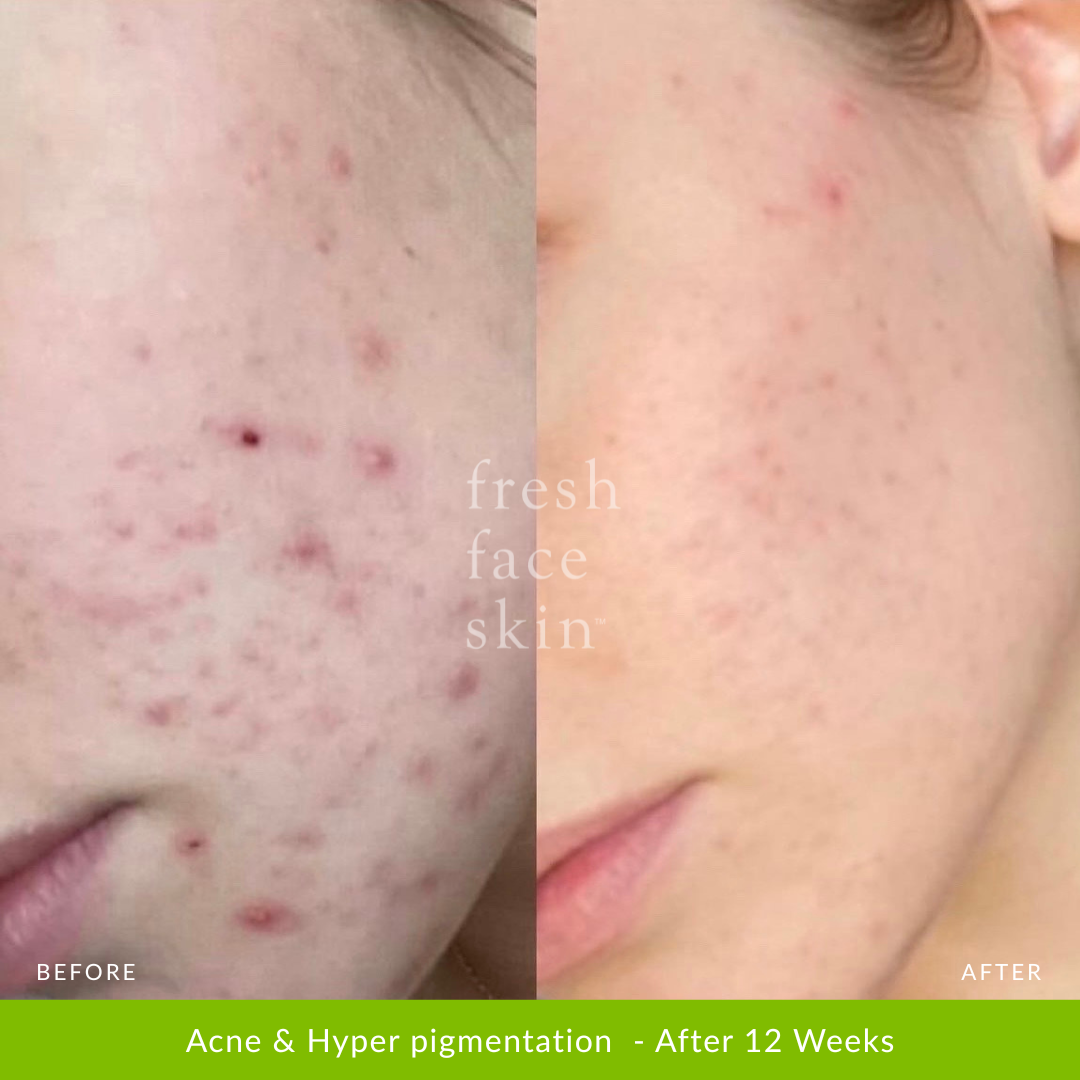 Acne & Hyper pigmentation  - After 12 Weeks