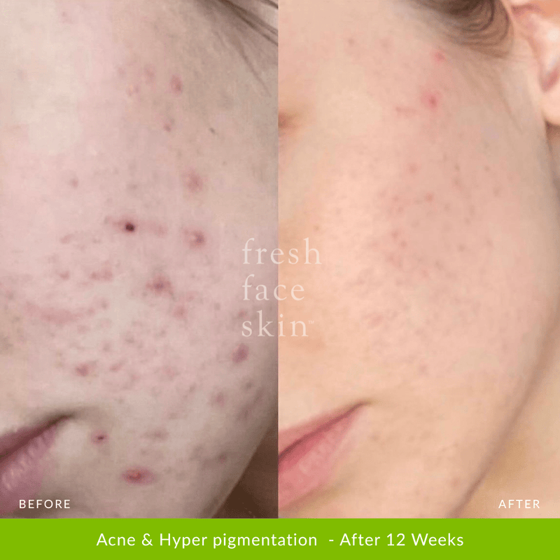 Healer Treatment - Fresh Face Skin