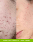 Healer Treatment - Fresh Face Skin