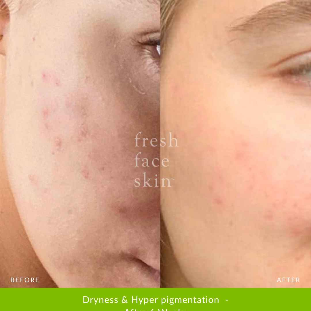 Reverser Treatment