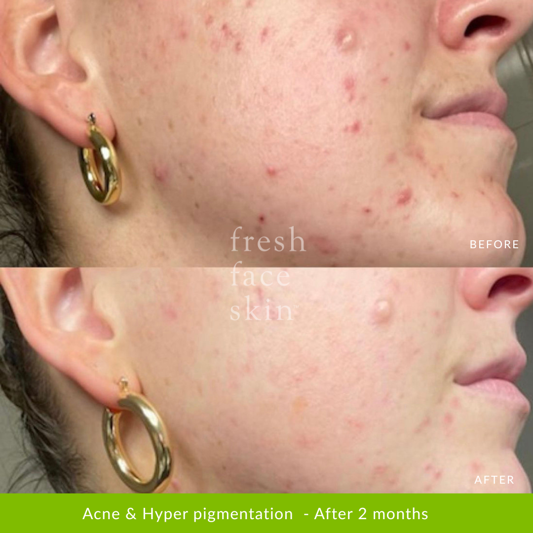 Acne & Hyper pigmentation  - After 2 months