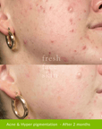 Healer Treatment - Fresh Face Skin
