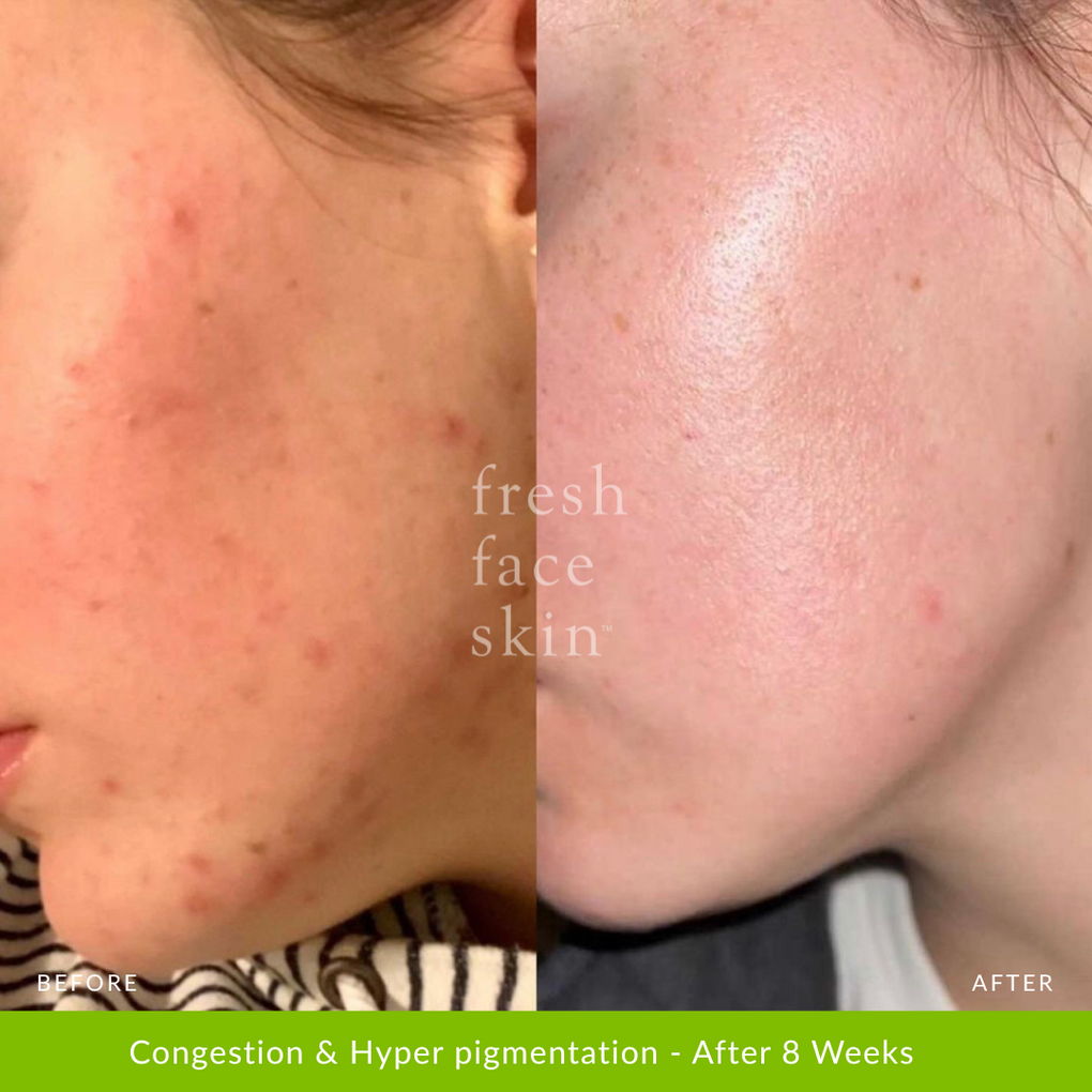 Congestion & Hyper pigmentation - After 8 Weeks
