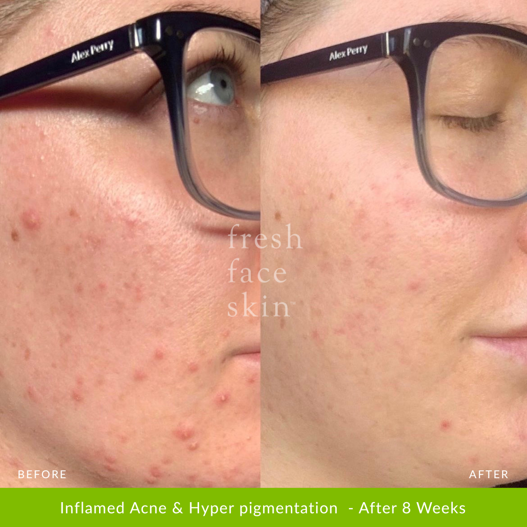 Inflamed Acne & Hyper pigmentation  - After 8 Weeks