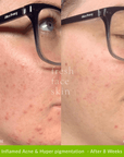 Healer Treatment - Fresh Face Skin