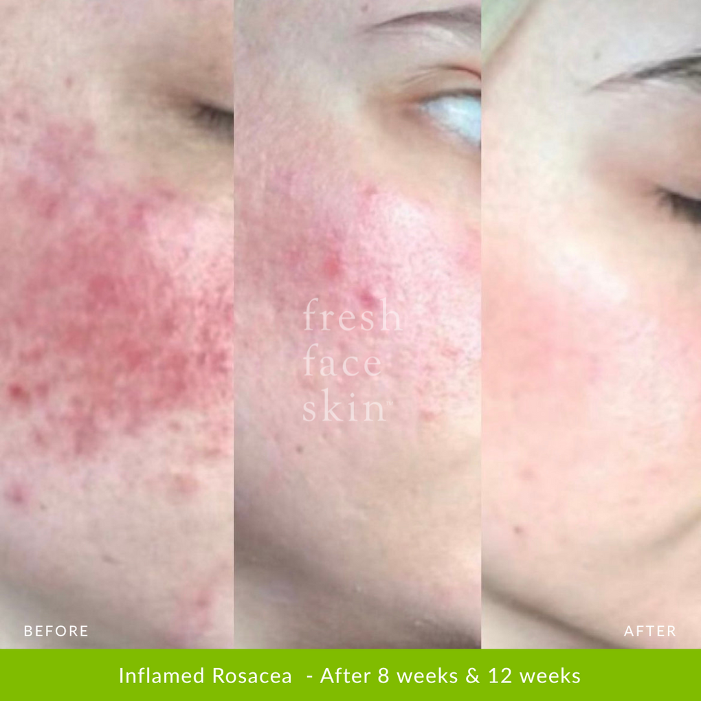 Inflamed Rosacea  - After 8 weeks & 12 weeks