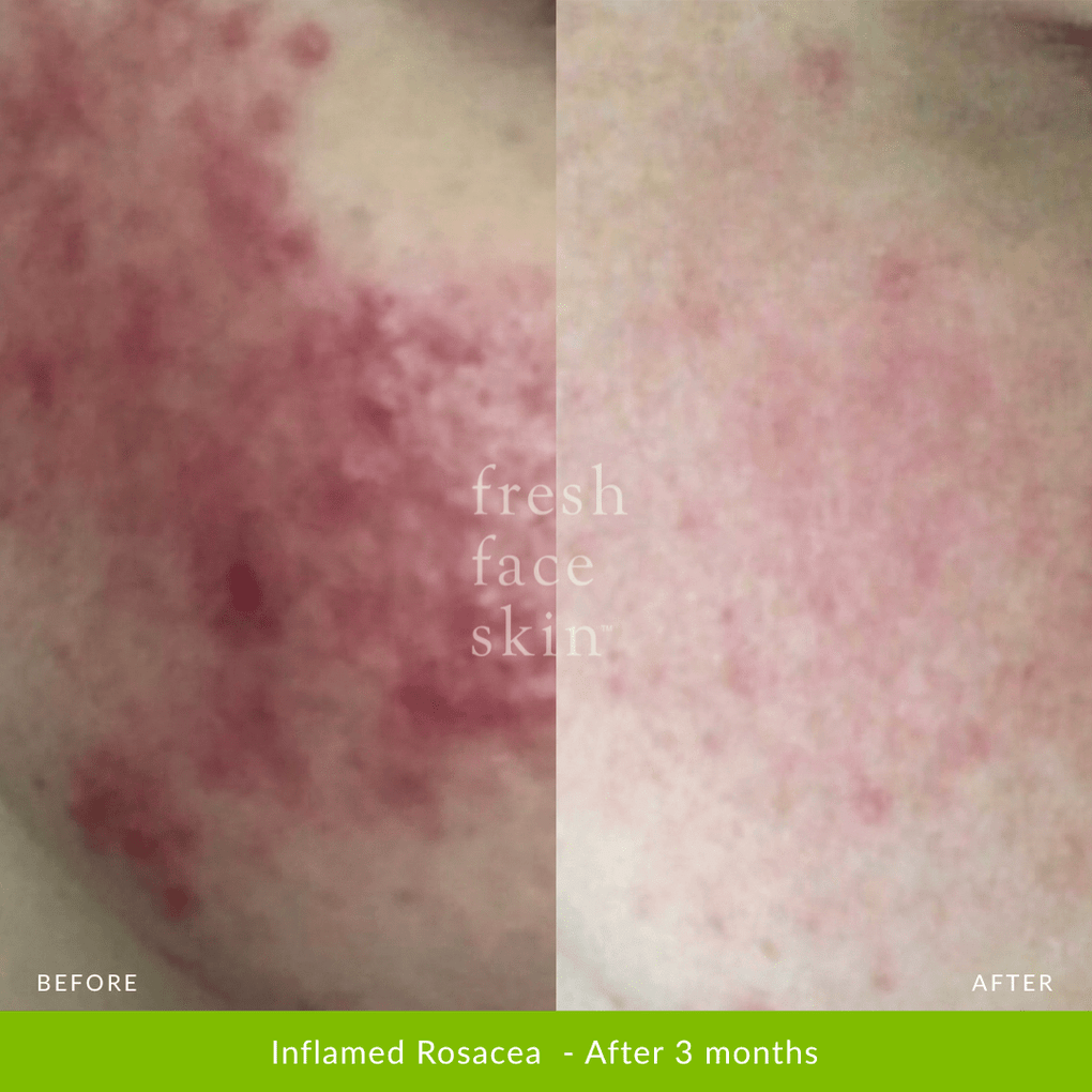 Skin Barrier Repair Pack - Fresh Face Skin