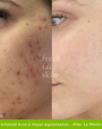 Reverser Treatment