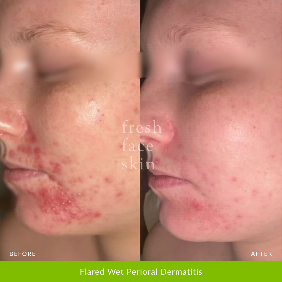 Flared Wet Perioral Dermatitis
