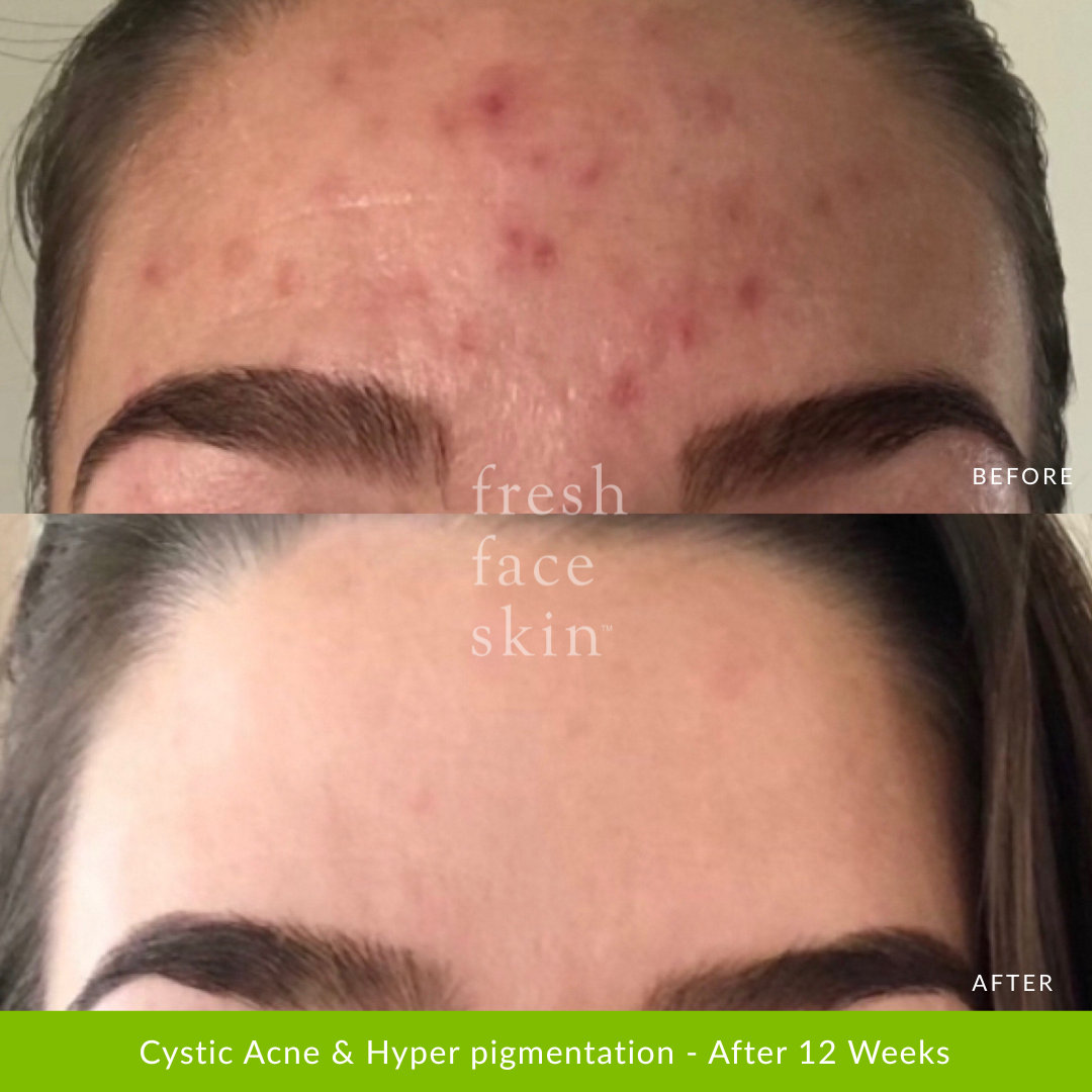 Acne Clearing Pack