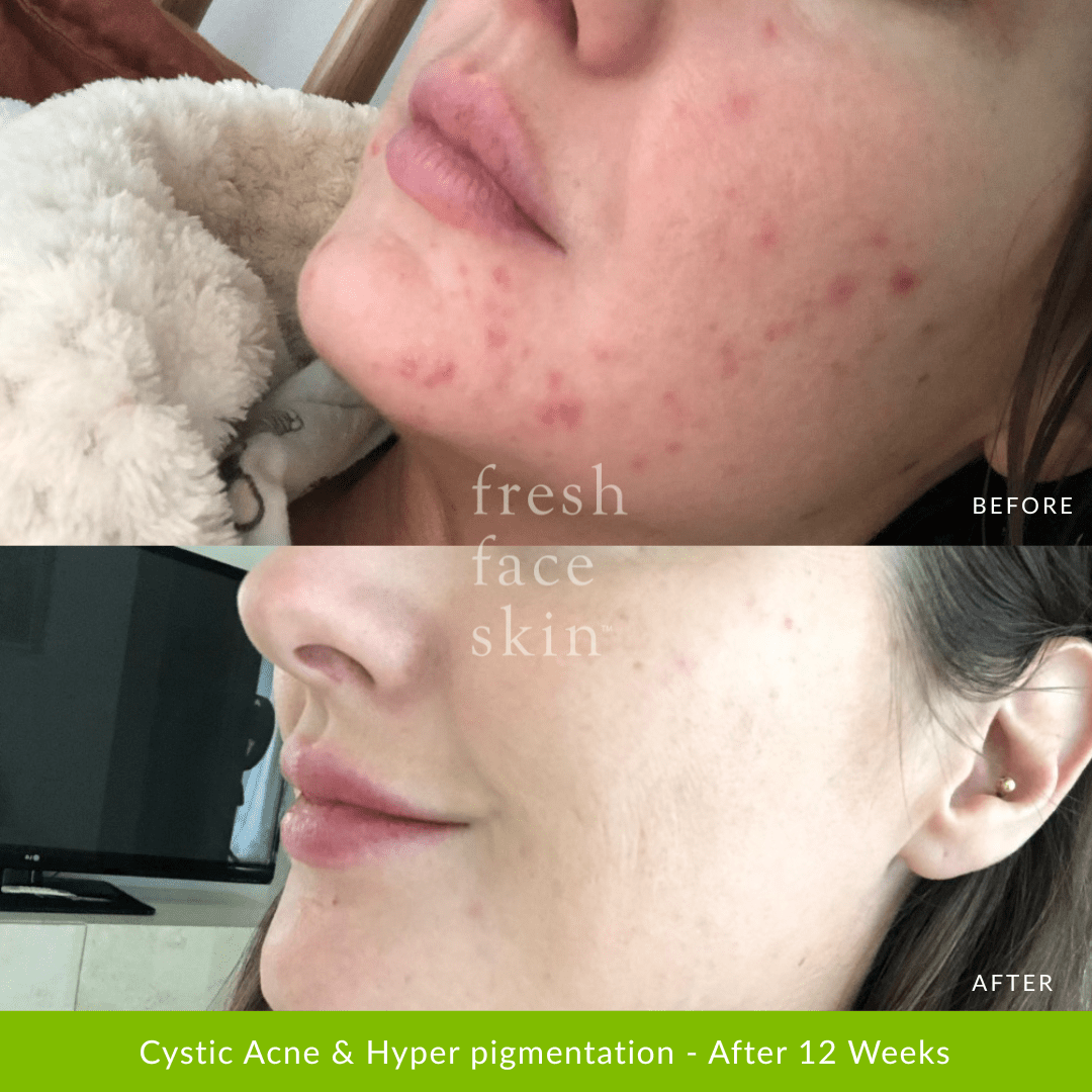 Healer Treatment - Fresh Face Skin