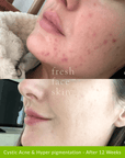 Healer Treatment - Fresh Face Skin
