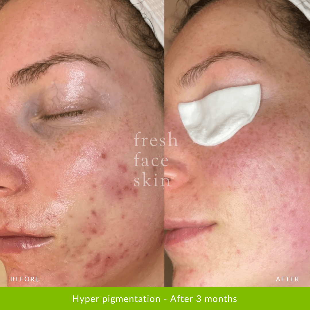 Healer Treatment - Fresh Face Skin