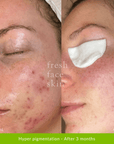 Healer Treatment - Fresh Face Skin