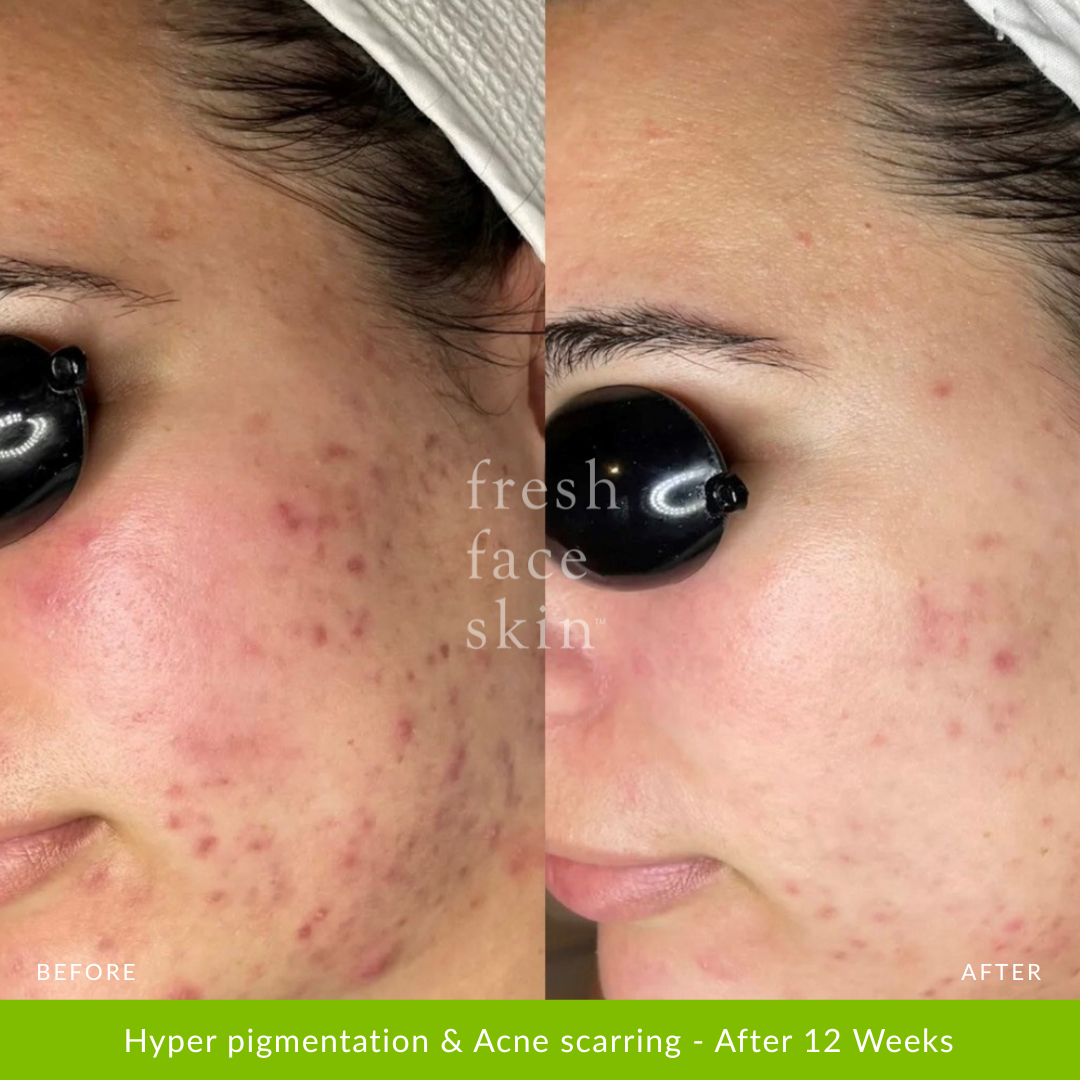 Acne Clearing Pack