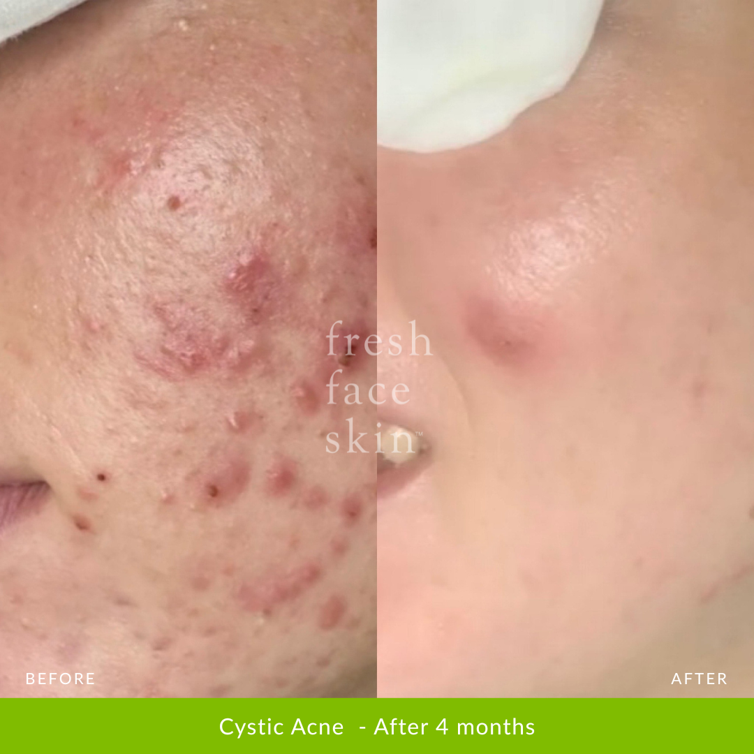 Acne Clearing Pack