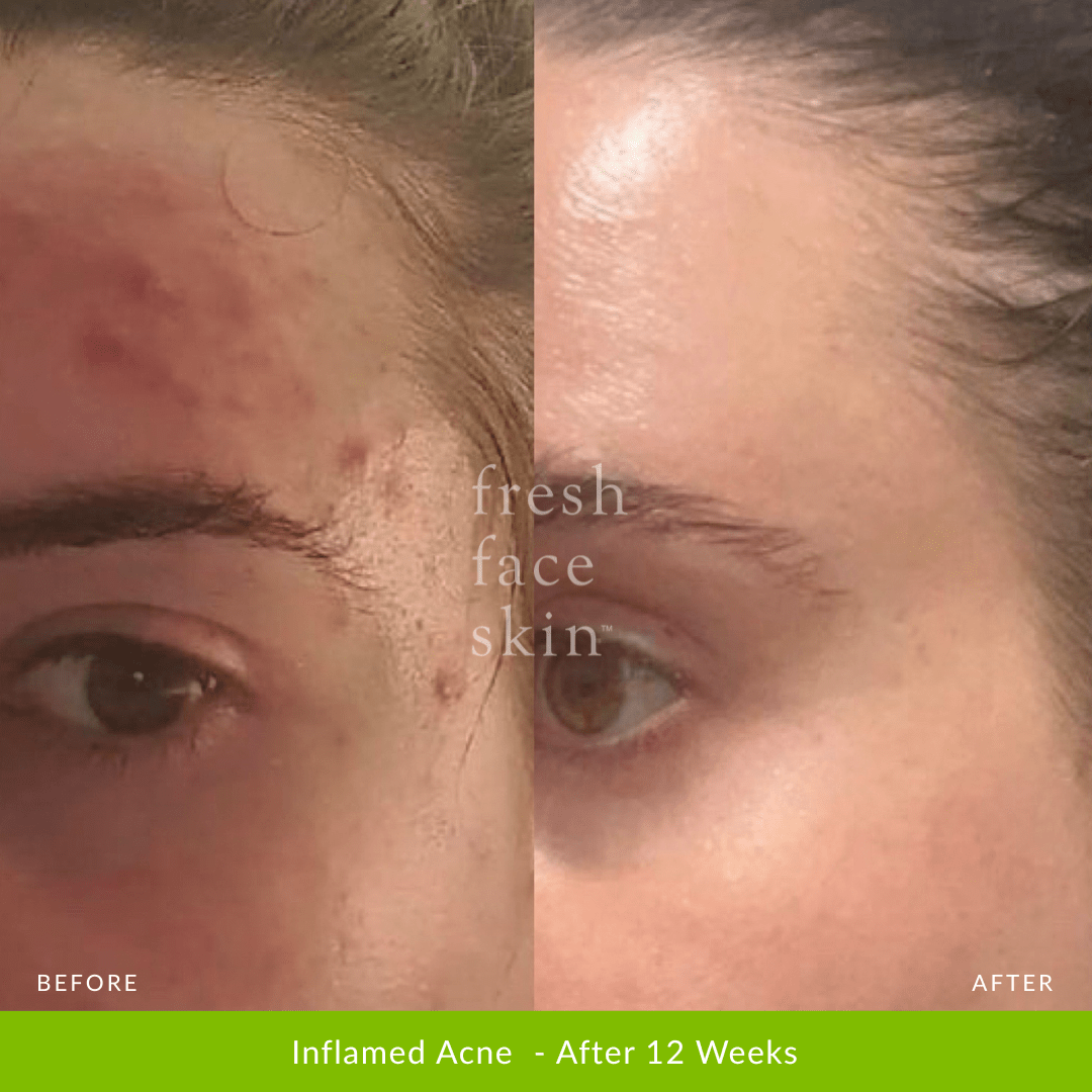 Healer Treatment - Fresh Face Skin