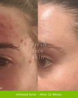 Healer Treatment - Fresh Face Skin