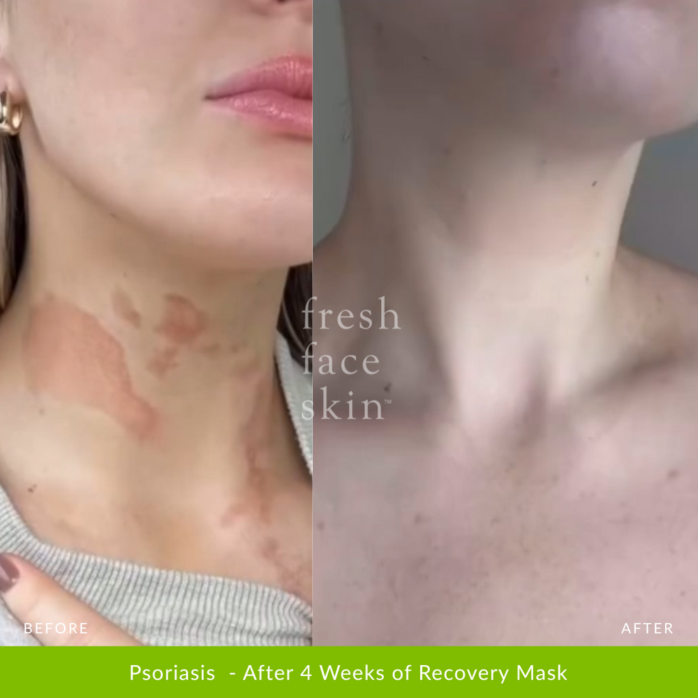 Psoriasis  - After 4 Weeks of Recovery Mask