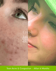 Healer Treatment - Fresh Face Skin