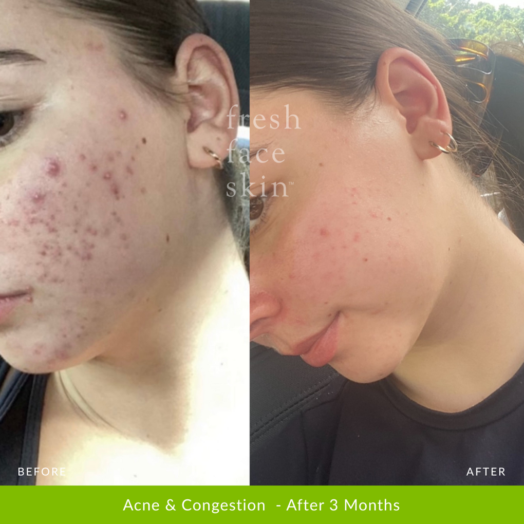 Acne & Congestion  - After 3 Months